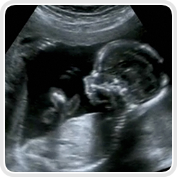 services-Nuchal-Translucency